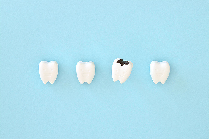 むし歯治療